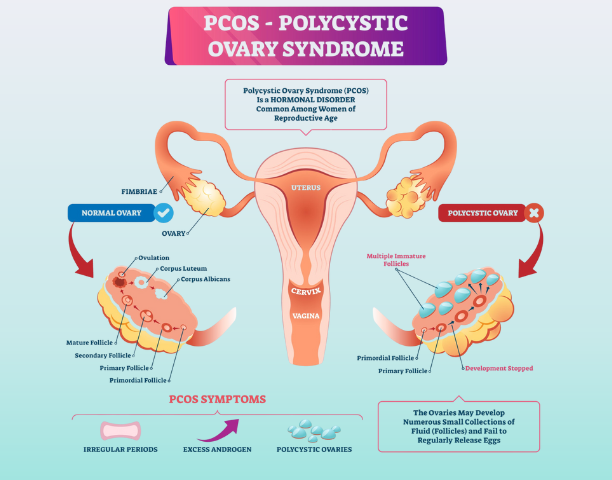 PCOS treatment at Mindshape Clinic